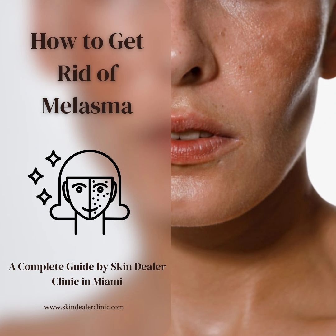 Exquisite Get Rid Melasma Artwork for Your Screen Exquisite Get Rid Melasma Artwork for Your Screen